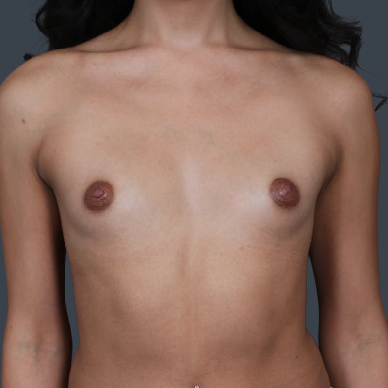 Breast Augmentation Before & After Gallery - Patient 354117 - Image 1
