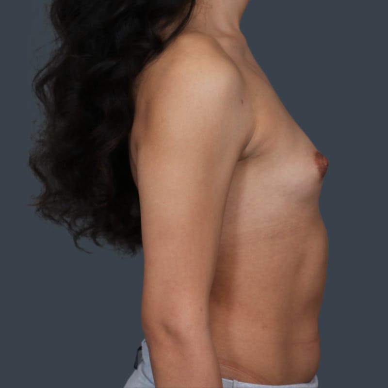 Breast Augmentation Before & After Gallery - Patient 354117 - Image 3