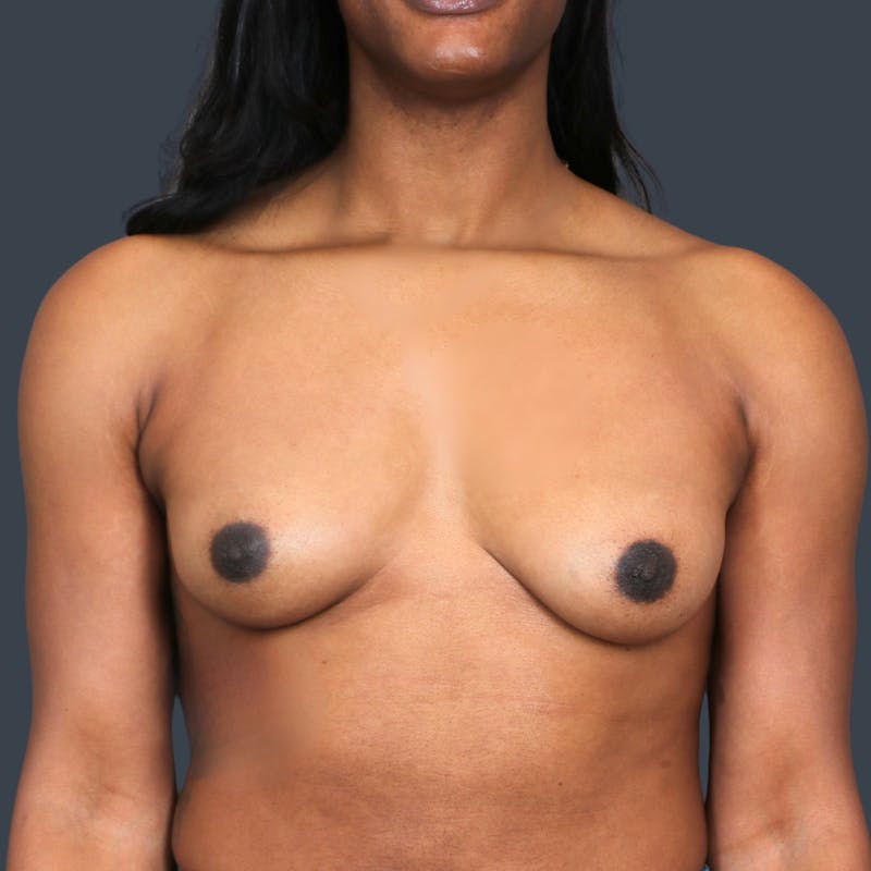 Breast Augmentation Before & After Gallery - Patient 212869 - Image 1