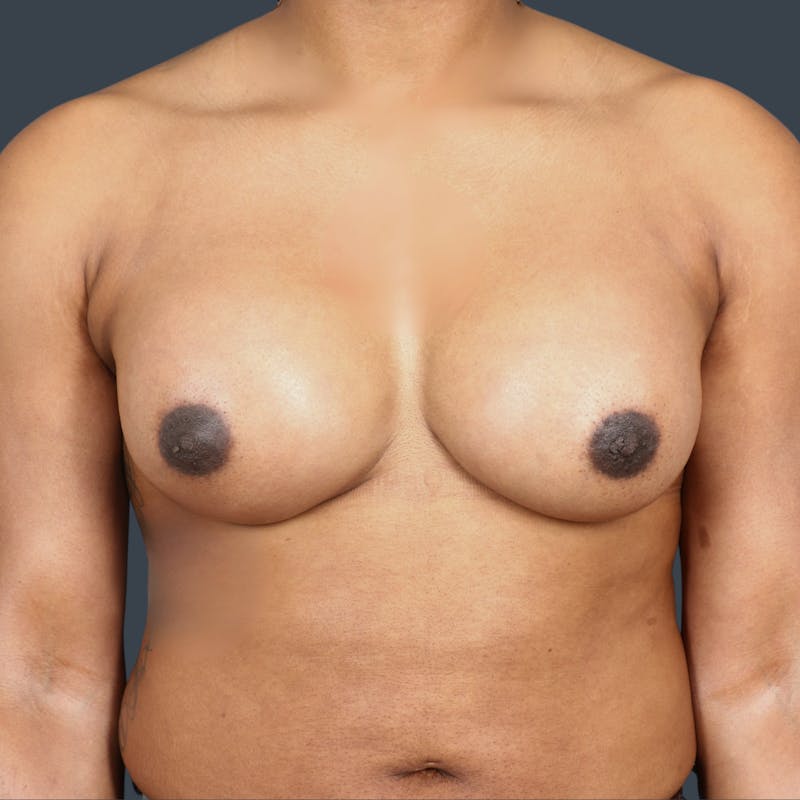 Breast Augmentation Before & After Gallery - Patient 212869 - Image 2