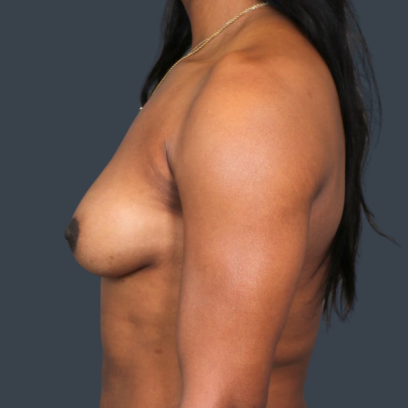 Breast Augmentation Before & After Gallery - Patient 212869 - Image 3