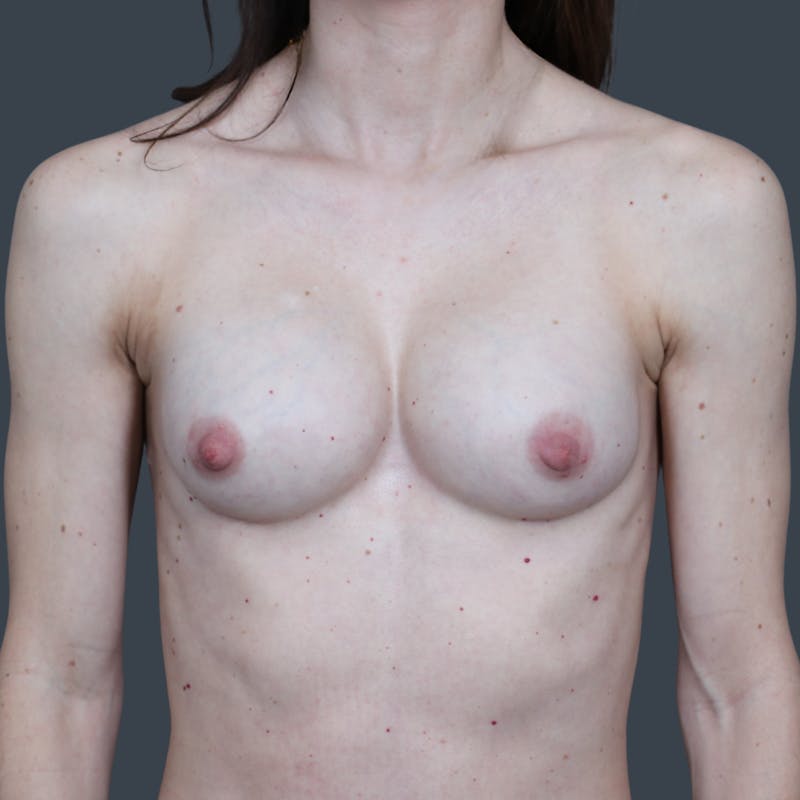 Implant Removal Before & After Gallery - Patient 326311 - Image 1