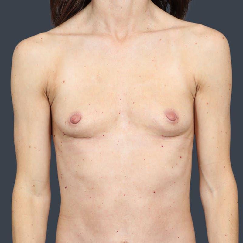 Implant Removal Before & After Gallery - Patient 326311 - Image 2