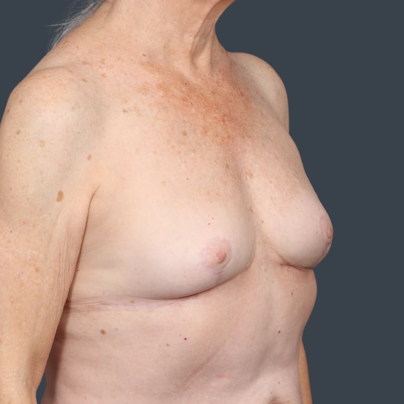 Implant Removal Before & After Gallery - Patient 563312 - Image 2