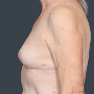 Implant Removal Before & After Gallery - Patient 563312 - Image 4