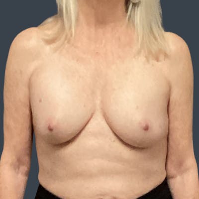 Oncoplastic/Lumpectomy Reconstruction Before & After Gallery - Patient 126746 - Image 1