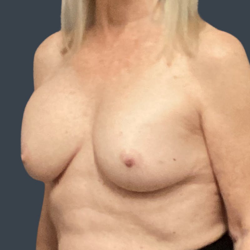 Oncoplastic/Lumpectomy Reconstruction Before & After Gallery - Patient 126746 - Image 3