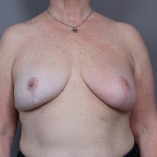 Oncoplastic/Lumpectomy Reconstruction Before & After Gallery - Patient 216116 - Image 2
