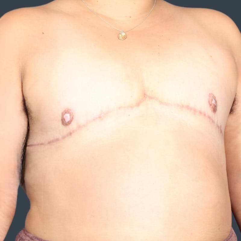 Top Surgery Before & After Gallery - Patient 284999 - Image 2
