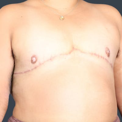 Top Surgery Before & After Gallery - Patient 284999 - Image 2