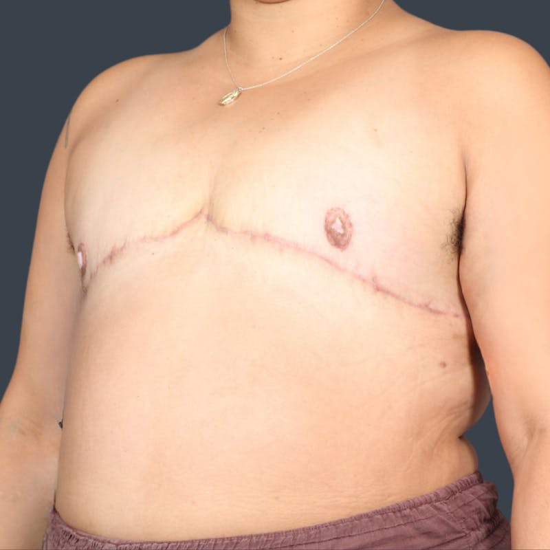 Top Surgery Before & After Gallery - Patient 284999 - Image 4
