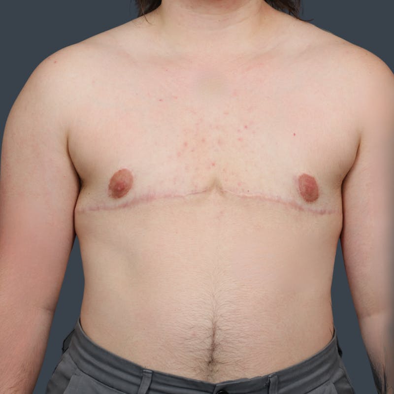 Top Surgery Before & After Gallery - Patient 188348 - Image 2