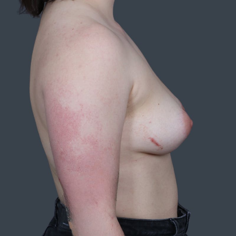 Top Surgery Before & After Gallery - Patient 188348 - Image 3