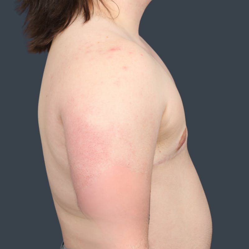 Top Surgery Before & After Gallery - Patient 188348 - Image 4