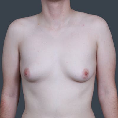 Top Surgery Before & After Gallery - Patient 296023 - Image 1