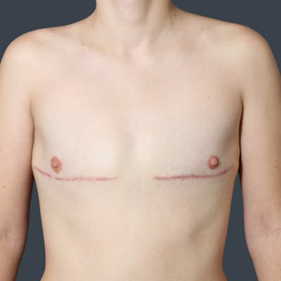 Top Surgery Before & After Gallery - Patient 296023 - Image 2