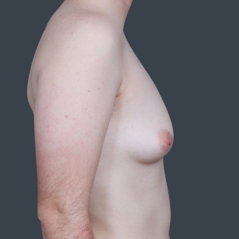 Top Surgery Before & After Gallery - Patient 296023 - Image 3