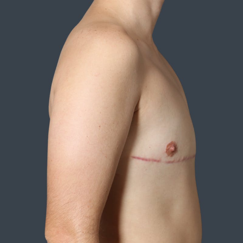 Top Surgery Before & After Gallery - Patient 296023 - Image 4