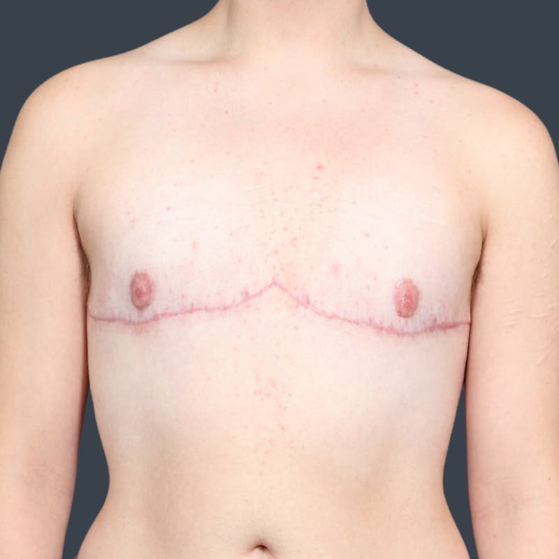Top Surgery Before & After Gallery - Patient 270443 - Image 2