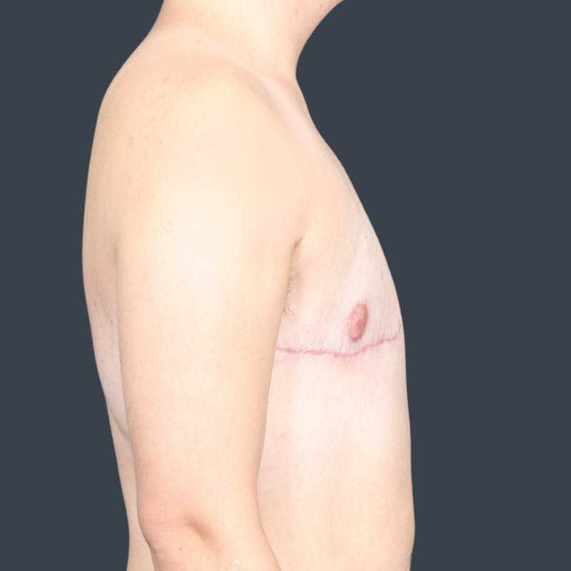 Top Surgery Before & After Gallery - Patient 270443 - Image 4