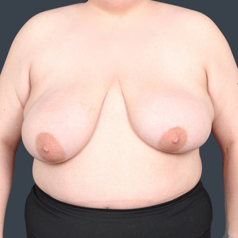 Top Surgery Before & After Gallery - Patient 302649 - Image 1