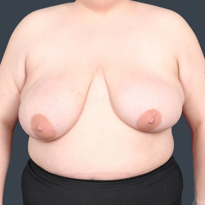 Top Surgery Before & After Gallery - Patient 302649 - Image 1