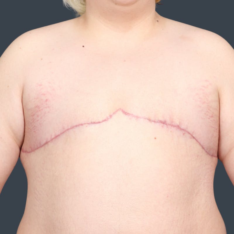 Top Surgery Before & After Gallery - Patient 302649 - Image 2