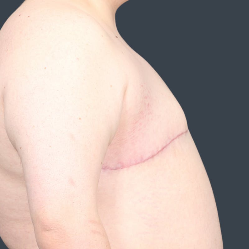 Top Surgery Before & After Gallery - Patient 302649 - Image 4
