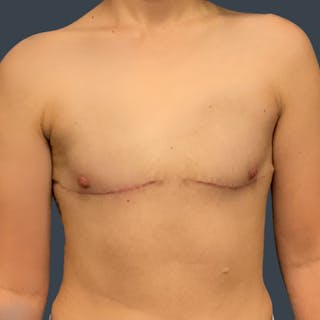 Top Surgery Before & After Gallery - Patient 368786 - Image 2