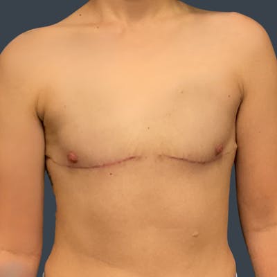Top Surgery Before & After Gallery - Patient 368786 - Image 2