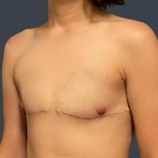 Top Surgery Before & After Gallery - Patient 368786 - Image 4