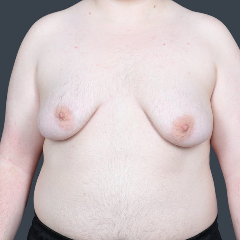 Top Surgery Before & After Gallery - Patient 254574 - Image 1