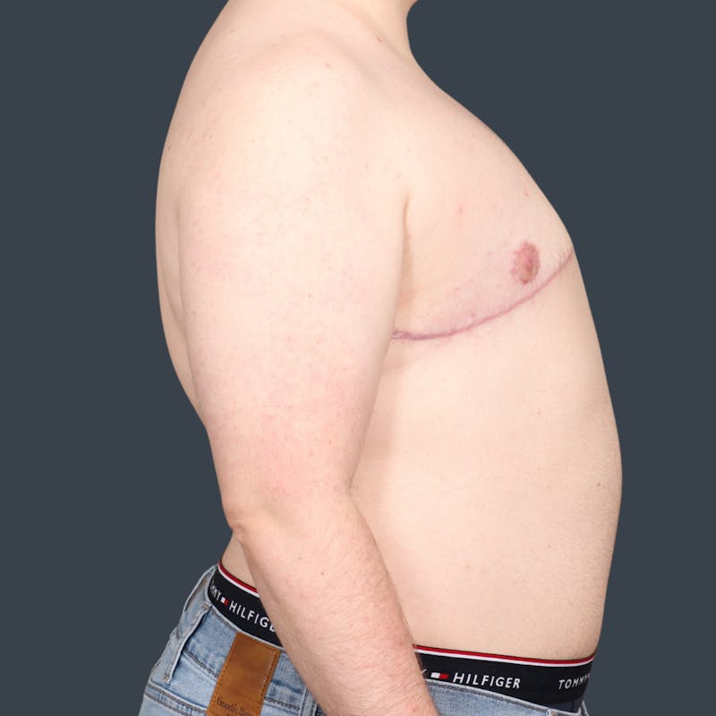 Top Surgery Before & After Gallery - Patient 254574 - Image 4