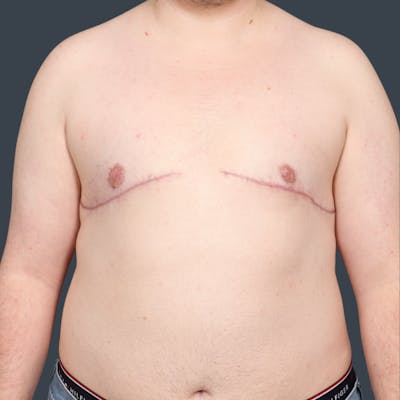 Top Surgery Before & After Gallery - Patient 254574 - Image 2