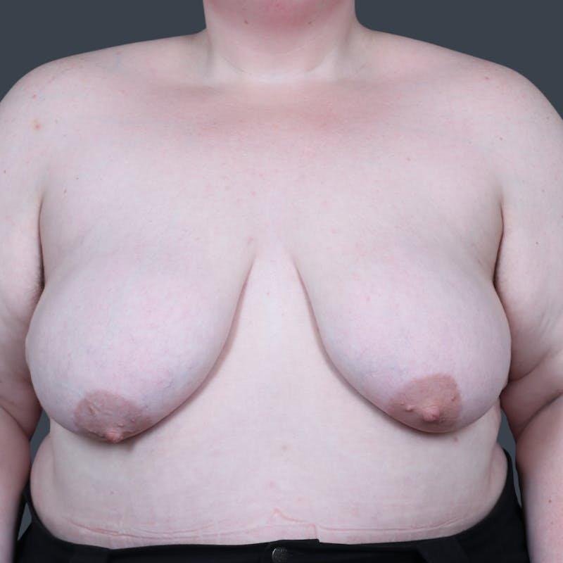 Top Surgery Before & After Gallery - Patient 396706 - Image 1