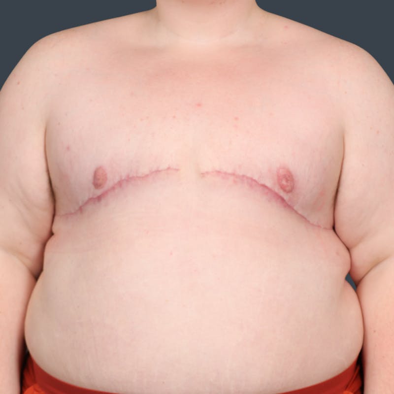 Top Surgery Before & After Gallery - Patient 396706 - Image 2