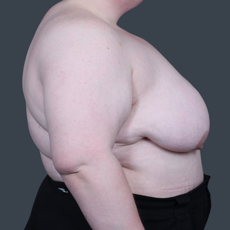 Top Surgery Before & After Gallery - Patient 396706 - Image 3