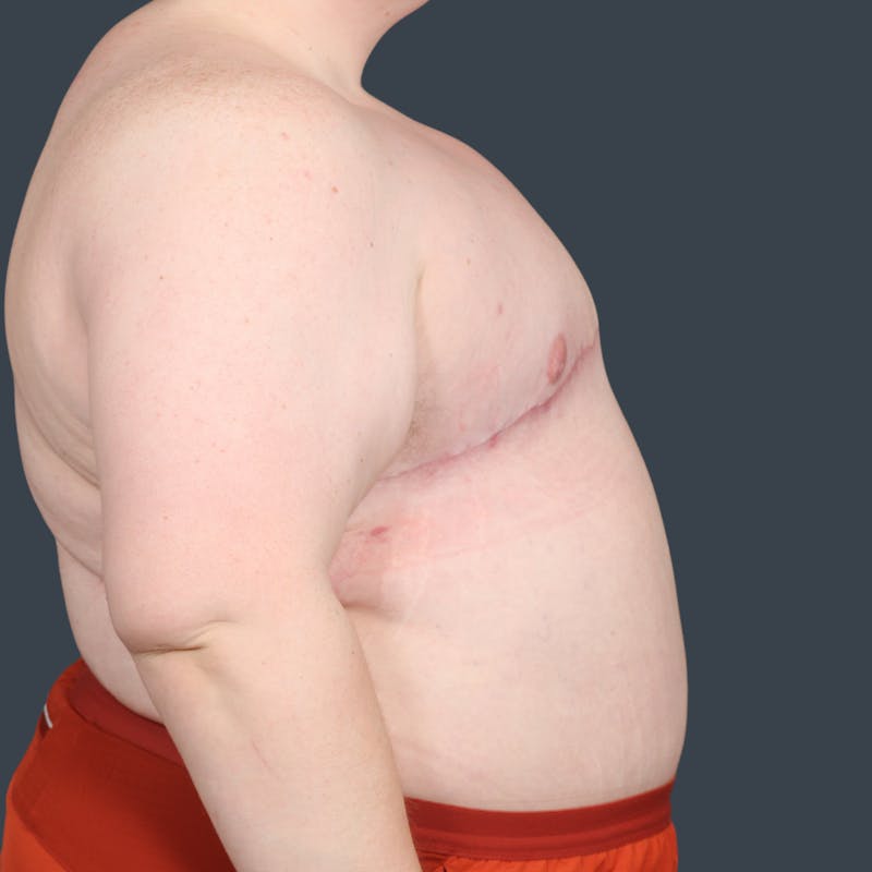 Top Surgery Before & After Gallery - Patient 396706 - Image 4