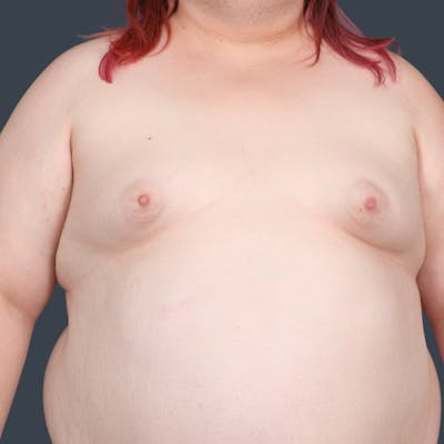 Top Surgery Before & After Gallery - Patient 393448 - Image 1