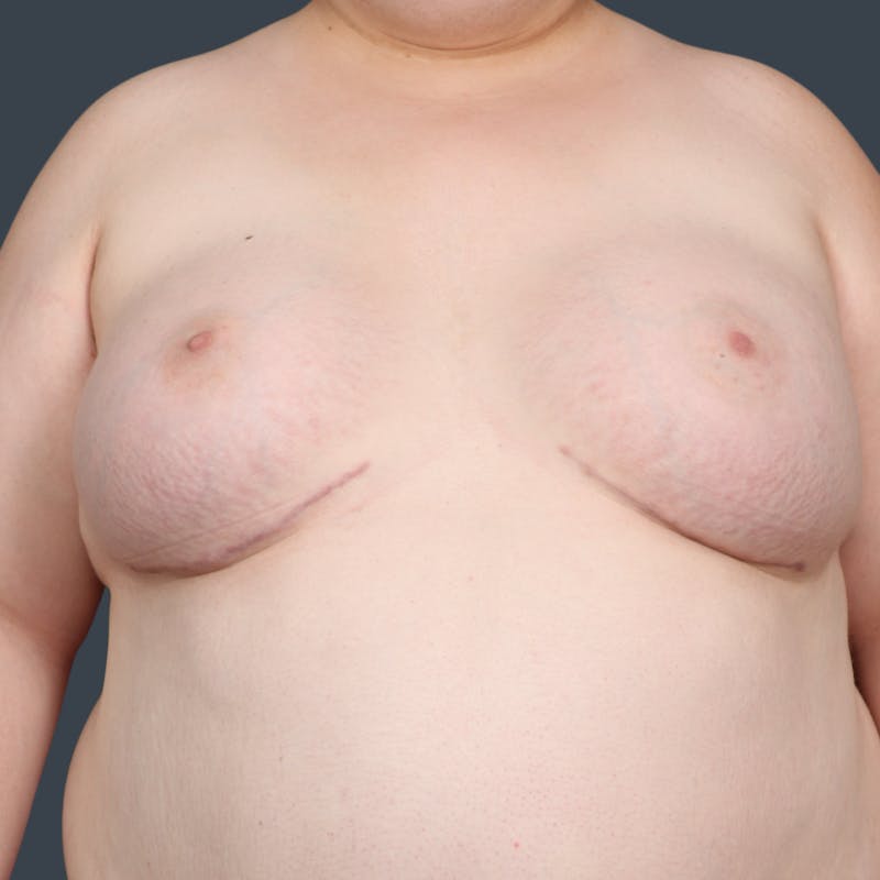 Top Surgery Before & After Gallery - Patient 393448 - Image 2