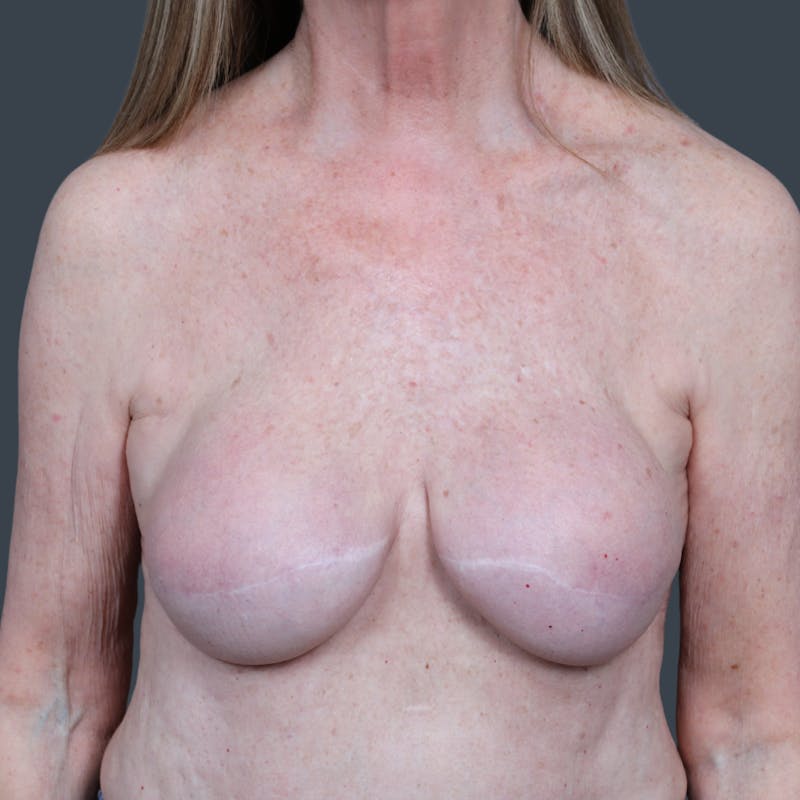 Breast Reconstruction Revision Before & After Gallery - Patient 370985 - Image 1