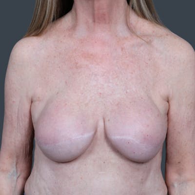 Breast Reconstruction Revision Before & After Gallery - Patient 370985 - Image 1