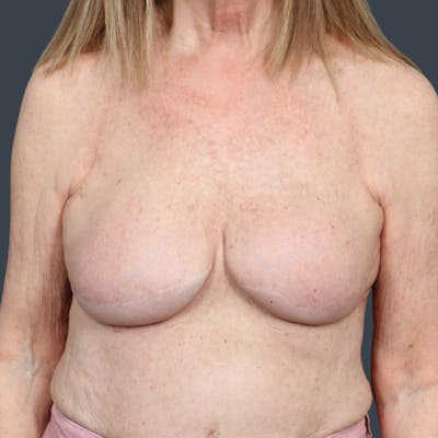 Breast Reconstruction Revision Before & After Gallery - Patient 370985 - Image 2