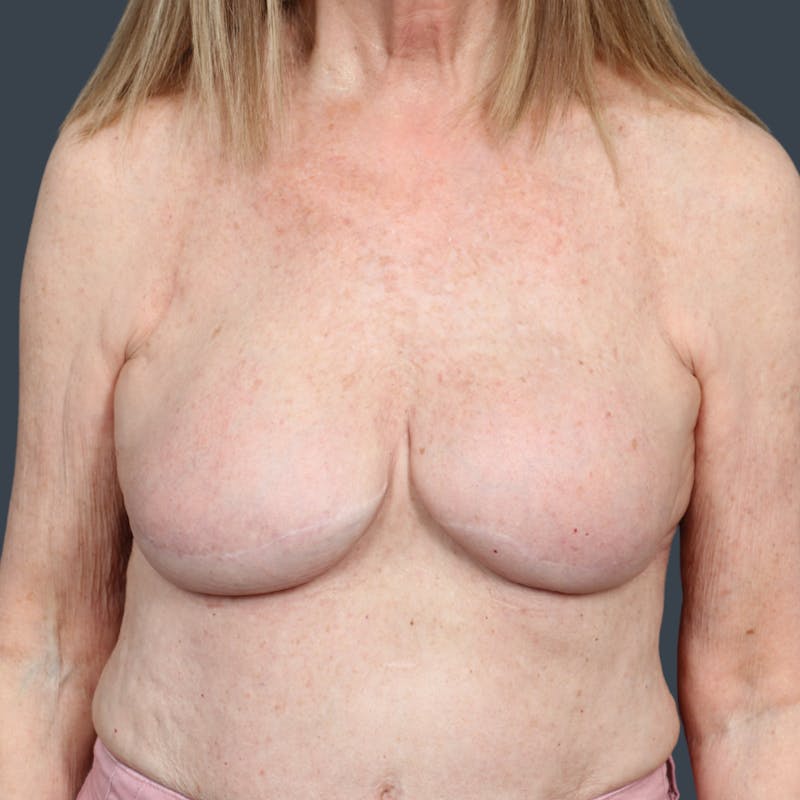 Breast Reconstruction Revision Before & After Gallery - Patient 370985 - Image 2