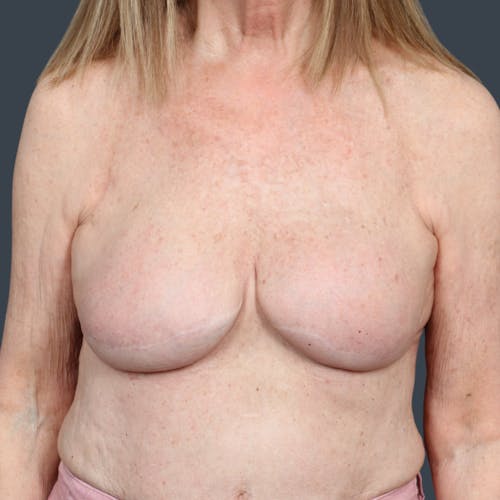 After procedure image for Breast Reconstruction Revision