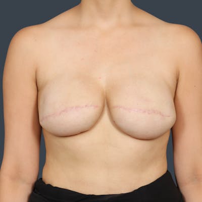 Breast Reconstruction Revision Before & After Gallery - Patient 105816 - Image 2