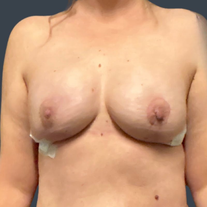 Implant Breast Reconstruction Before & After Gallery - Patient 120872 - Image 2