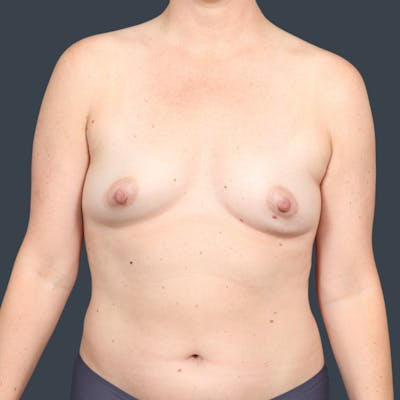 Implant Breast Reconstruction Before & After Gallery - Patient 255646 - Image 1