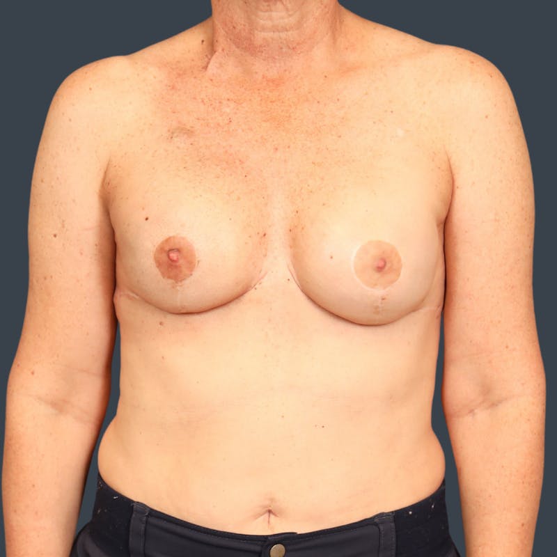 Implant Breast Reconstruction Before & After Gallery - Patient 378483 - Image 2