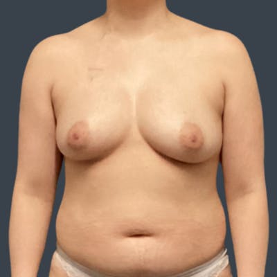 Implant Breast Reconstruction Before & After Gallery - Patient 324780 - Image 2